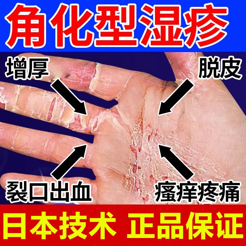 日本角化型湿疹手癣膏脱皮正品