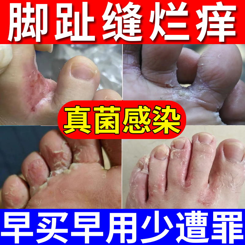 糜烂性脚气烂脚丫脚趾缝脱皮脚痒脚趾真菌感染专用喷剂药房同款JW