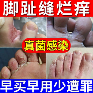 糜烂性脚气烂脚丫脚趾缝脱皮脚痒脚趾真菌感染专用喷剂药房同款JW
