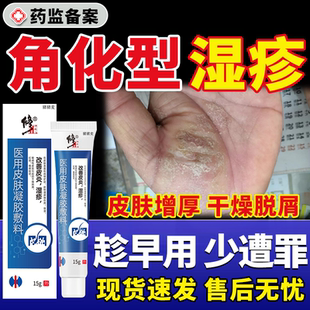 角化型手部湿疹皮肤真菌感染去止痒根手癣膏脱皮干裂角质化皲裂JW