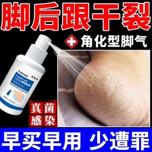 脚后跟干裂开裂真菌感染鳞屑角化型脚气角化性药房同款专用喷雾JW