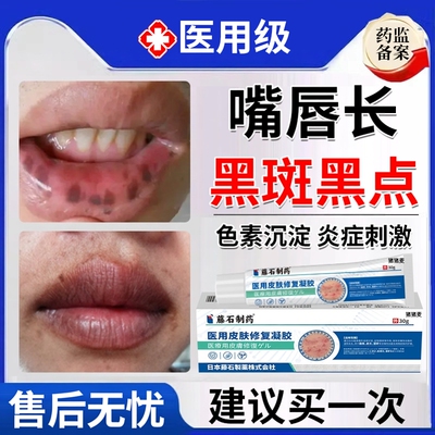 【藤石制药】嘴唇黑斑色素沉着