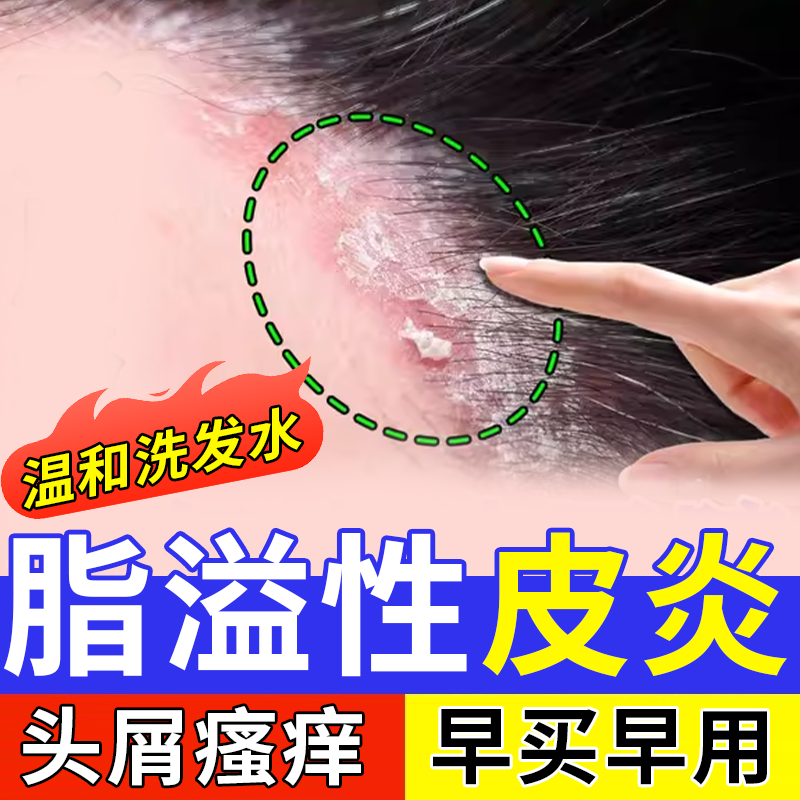 头发头皮精华煤焦油洗剂脂溢性皮炎去屑止痒洗发水头部儿童男女OZ