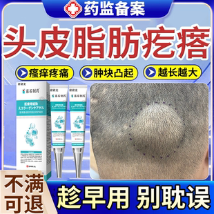 头上长硬疙瘩头皮下脂肪瘤去除神器后脑勺头部表皮囊肿额头鼓包EM