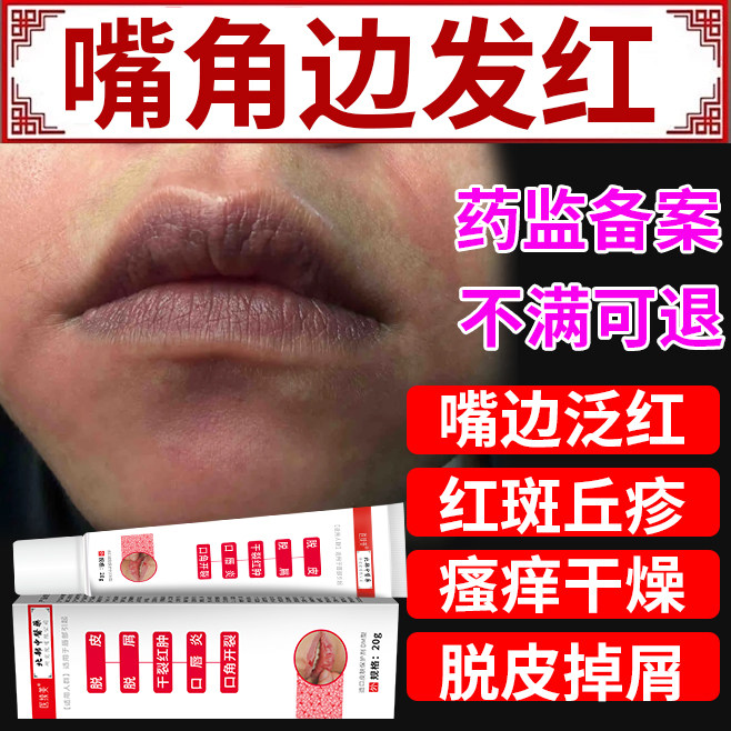 口周皮炎唇周炎专用过敏嘴角边湿疹嘴巴周围一圈发红薬房同款膏y3