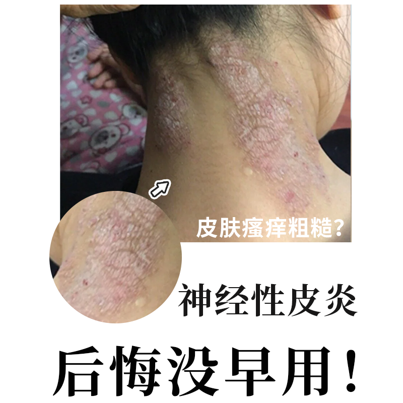 【现货速发】神经性皮炎止痒喷雾