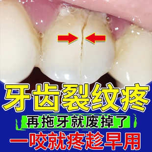 牙齿有裂纹裂开牙裂缝修补牙隐裂修牙膏复断裂医用型牙裂生长液OZ