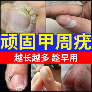 甲周疣甲下专用手指手上长硬疙瘩硬皮寻常疣去除hpv药房同款膏JW