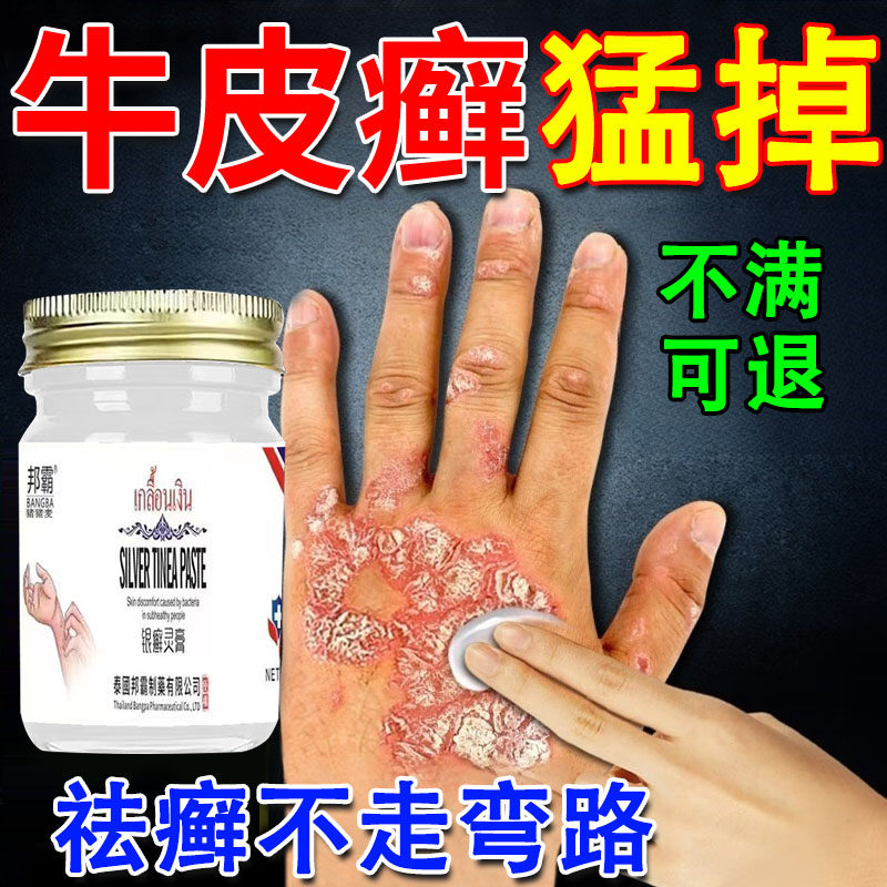牛皮癣藓癬银屑病专用手足癣体癣真菌感染药膏去癣止痒搭洗发水JW