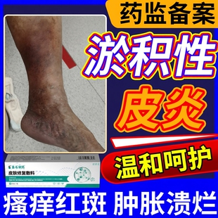 淤积性皮炎静脉曲张炎淤滞专用皮肤软化药房同款膏湿疹去止痒根BS
