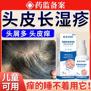 头皮湿疹头皮屑脂溢性皮炎可搭洗发水真菌感染头癣专用头部喷剂JW