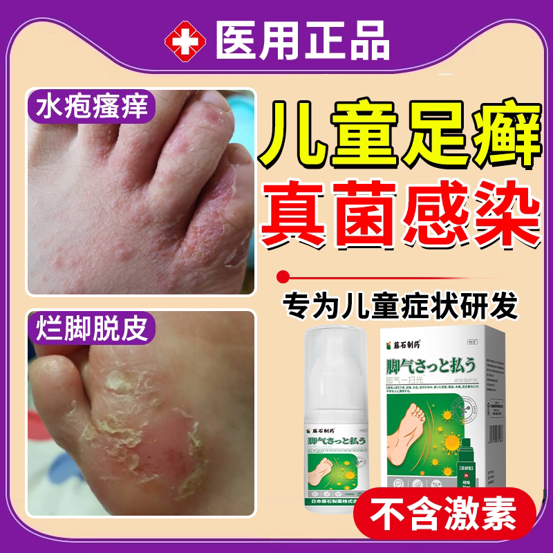 儿童足癣脚癣一次真菌感染净去脚气脚藓根止痒泡脚喷剂可搭药膏jw