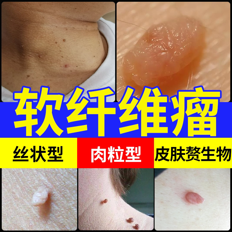 皮肤软纤维瘤去除神器搭丝状疣药膏身上脖子上长小肉粒皮赘肉瘤jw