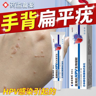 手背扁平疣去疣根hpv病毒可搭干扰素b2凝胶药膏用什么专用软膏JW