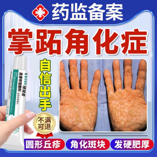 掌跖趾拓角化症手掌硬皮病症薬膏脓疱专用手指皮肤变硬发硬脱皮OZ