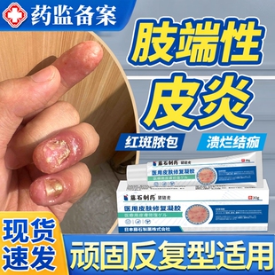 连续性肢端皮炎掌跖脓疱搭膏药贴银屑病甲手上长小水泡烂痒脱皮JW