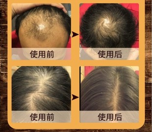 防脱育发液发际线头发增长液快速生发增发密发精华滚珠神器男女生