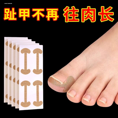 甲沟矫正器嵌甲往肉里长专用隔离贴片纠正脚趾甲指甲填充垫神器炎