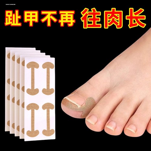 甲沟矫正器嵌甲往肉里长专用隔离贴片纠正脚趾甲指甲填充垫神器炎