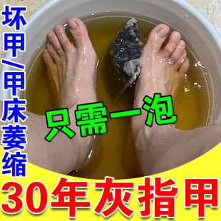 灰指甲泡脚药包药水专用杀真菌去脚气甲床增厚分离亮甲特效中药包