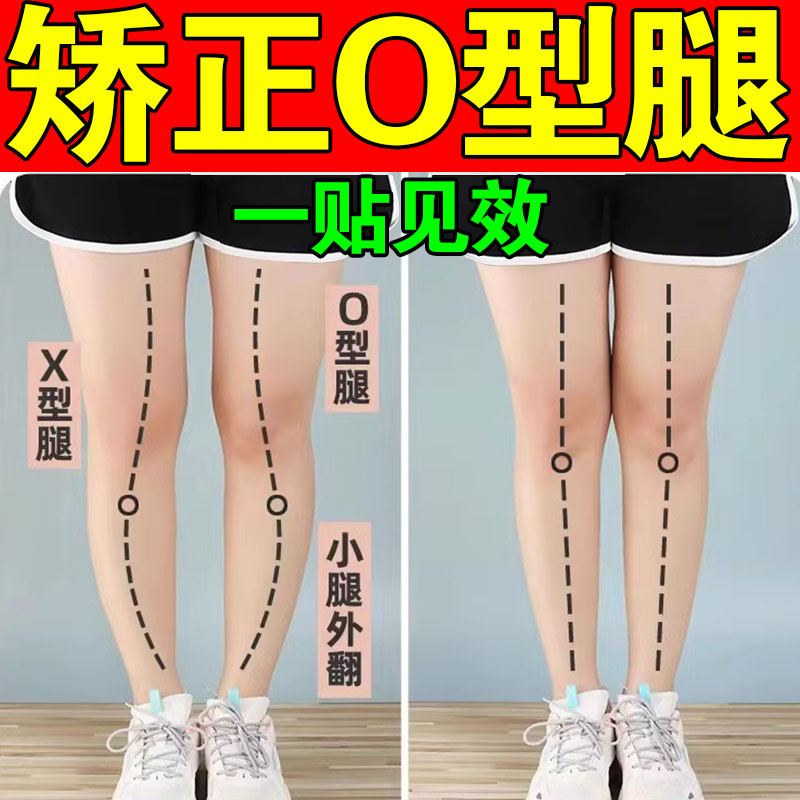 日本O型腿矫正神器小腿外翻改善X型腿罗圈腿内八腿鞋垫专用直腿贴