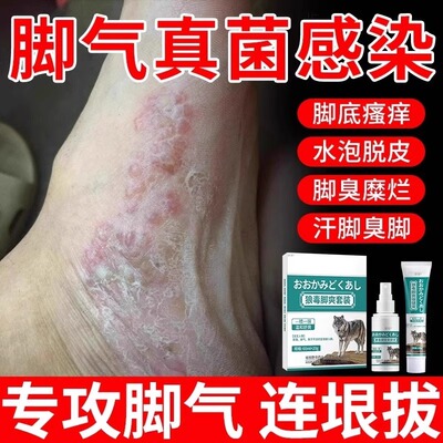 脚气烂脚丫药脱皮糜烂脚趾