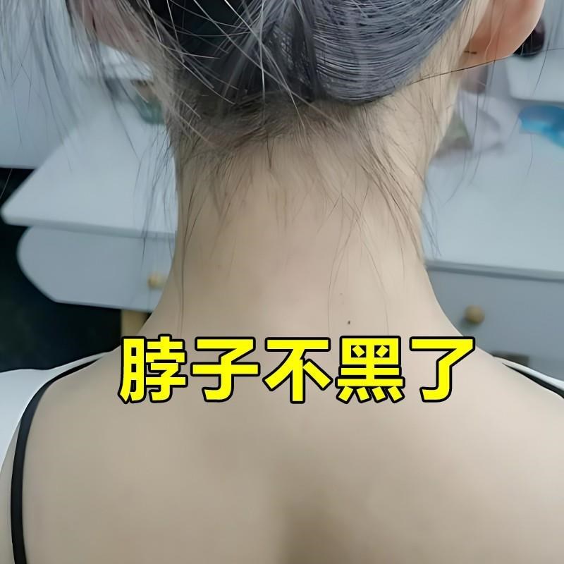 去脖子黑黑的棘皮药膏去除色素沉淀关节腋下洗不干净怎么变白神器