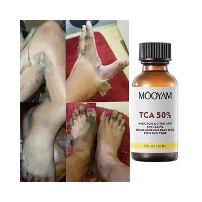 TCA 50% Chemical Peel Tca Peel Acid SkMin Superforce Peel