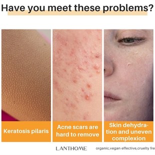 Lightening Soap Kojic Dark Whitening Skin Acid Black