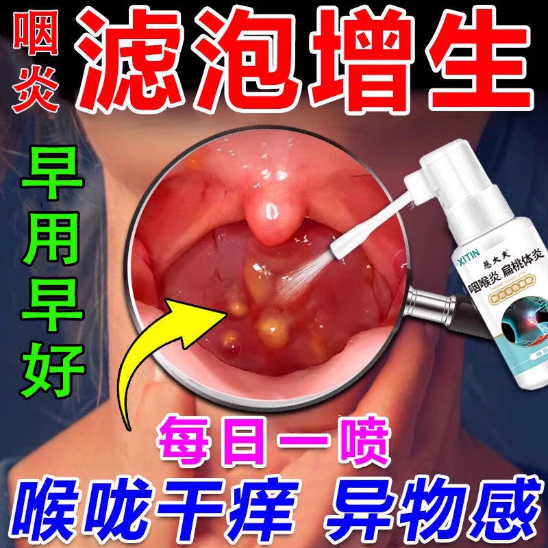 治疗喉咙滤泡增生后壁淋巴慢性咽炎咽喉炎根专慢性咽炎除用喷剂
