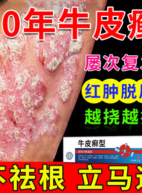 【牛皮癣药膏】银屑病真菌感染药