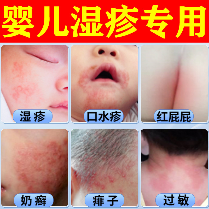 婴儿湿疹专用宝宝奶藓膏口水疹霜幼儿热疹草止痒脸部红屁痱淹脖子