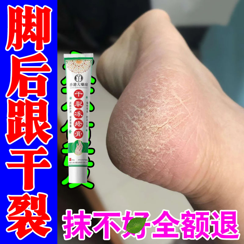 脚后跟干裂手足脱皮脚裂足跟开裂去死皮角质增厚硬茧