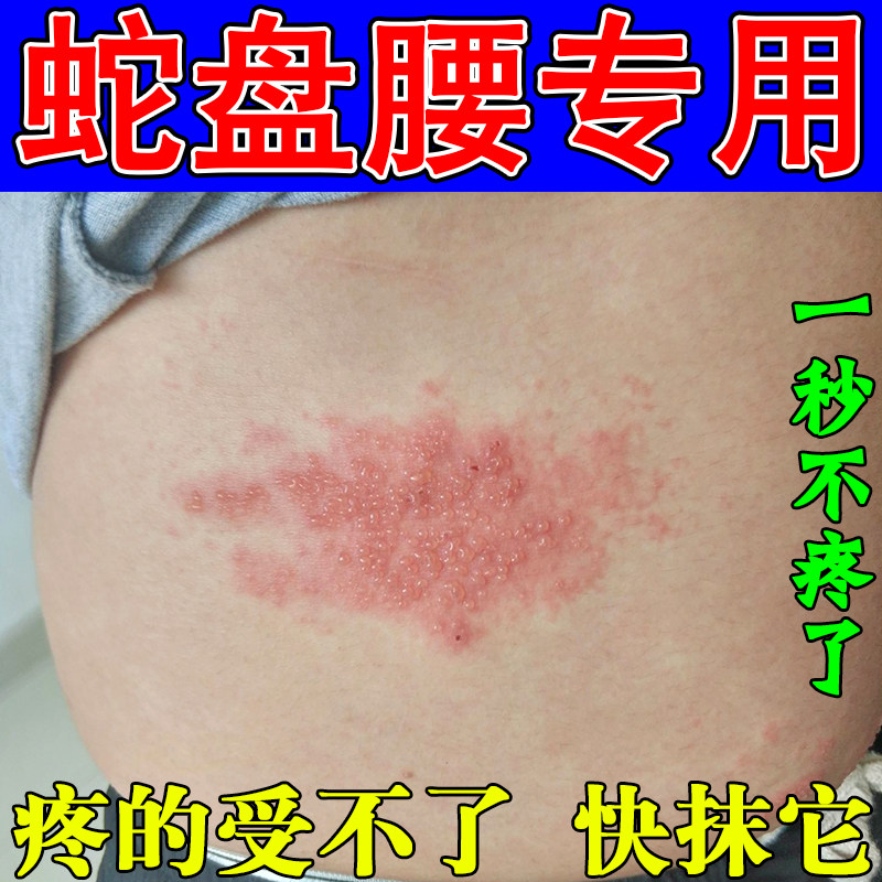 蛇缠腰后遗症带状蜘蛛疮皮肤外用软膏