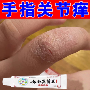 手指关节痒脱皮干裂关节处长硬疙瘩手痒修复膏