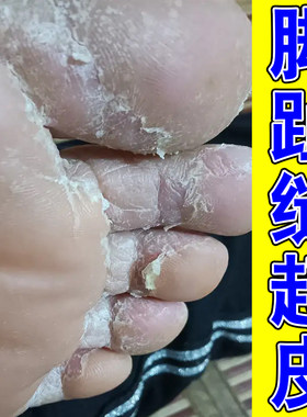 脚趾缝起干皮脚皮脱脚药丫痒皮起感染水小泡脚出发汗白专用膏