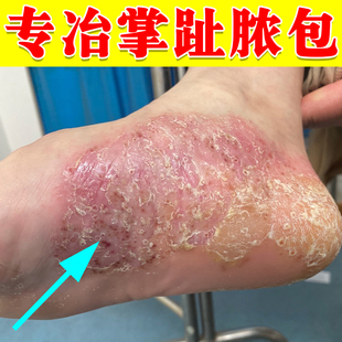 掌趾脓疱病掌跖脓包角化病症手脚脱皮干裂角皮症专用膏