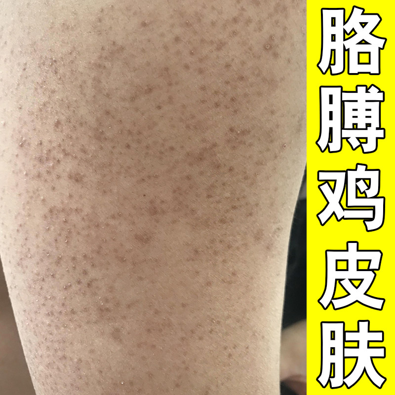 手臂鸡皮疙瘩毛囊毛周角化去胳膊皮肤消毒护理（消）