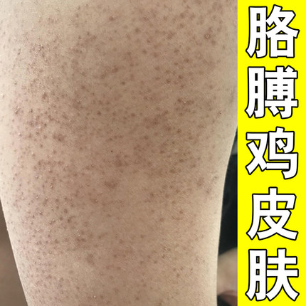 手臂鸡皮疙瘩毛囊毛周角化去胳膊腿上黑点角质毛孔堵塞专用