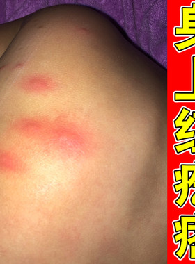 身上臭虫叮咬消肿臭虫外用毒虫蜱虫长虱子蚊子叮咬红肿喷剂