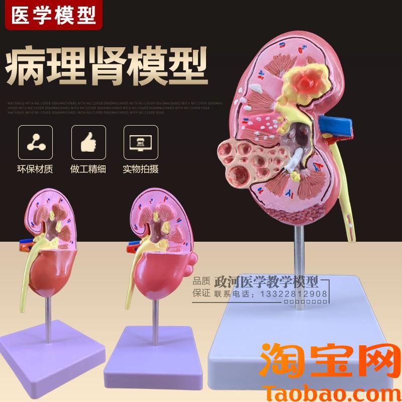 原装适用人体肾解剖模型,病理肾脏模型正常肾部模型专业内脏器官