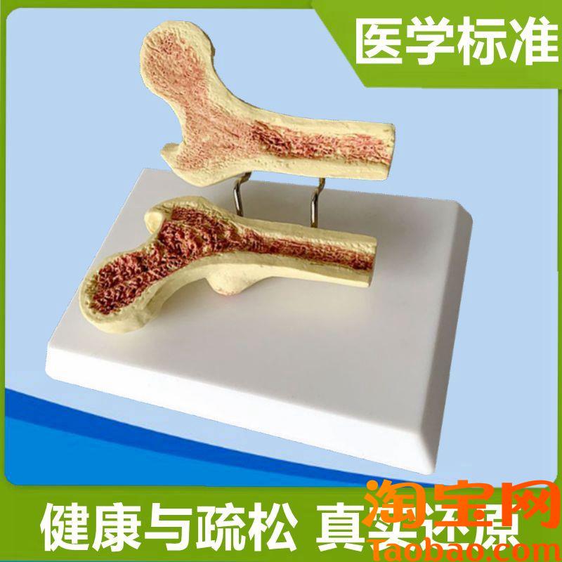 骨质密度模型疏松股骨头仿真塑胶骨头人体松质骨骨小.梁医药礼品