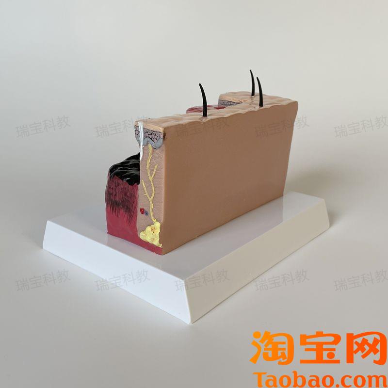 原装适用皮肤烧伤程度整形外科病理烫伤皮下组织变化医美微整形人