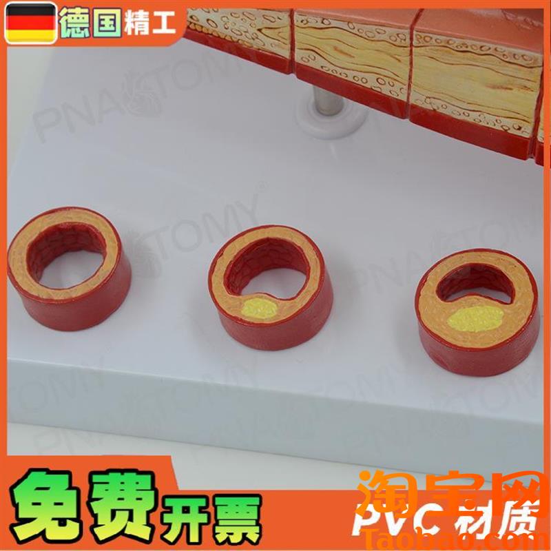 原装适用德国】人体动脉血管堵塞模型心脑血管血栓/硬化模型教学