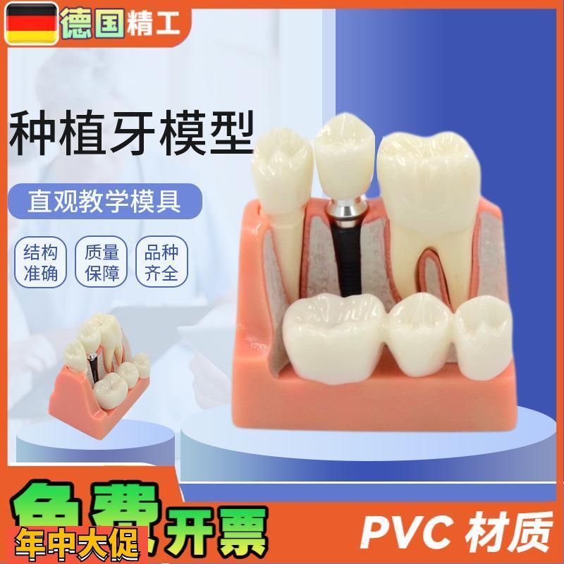 德国】种植牙模型人体口腔牙齿模型透明牙模型牙种植模型