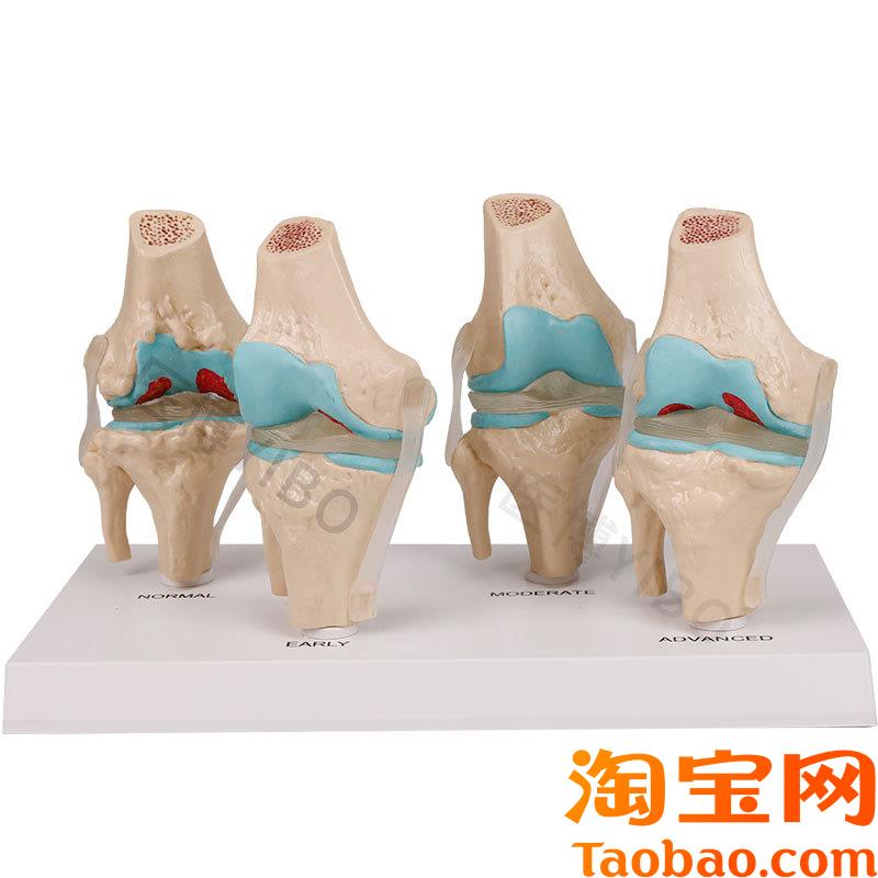 原装适用医博BIX-A3571膝关节病变模型人体骨骼病变模型人体膝关