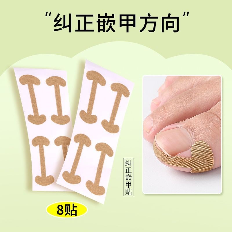 甲沟矫正器嵌甲往肉里长贴片纠正脚趾甲指甲填充垫神器炎棉花