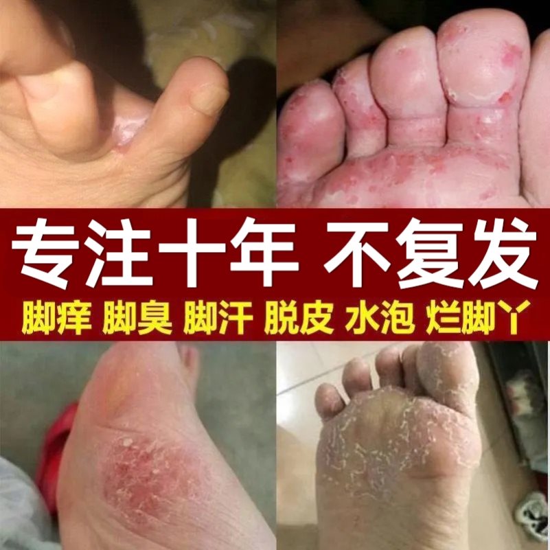 脚痒c止痒膏杀菌脚气草本脚臭泡脚药包脚气杀菌水泡型