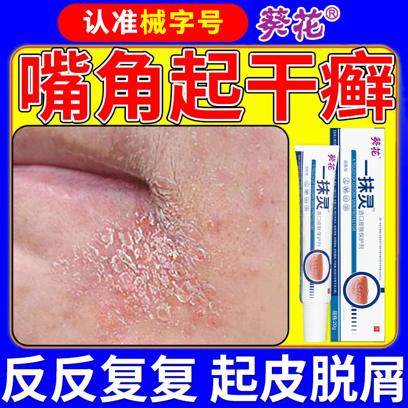嘴角下巴脸上长癣有藓起皮干燥红痒有碎屑溢脂性特异性皮炎