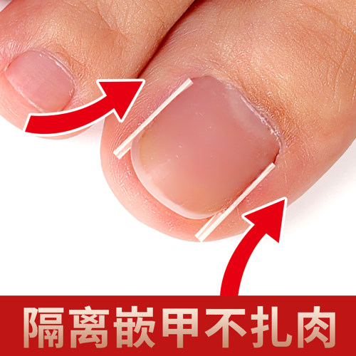 脚趾正甲贴神器专用填充垫炎